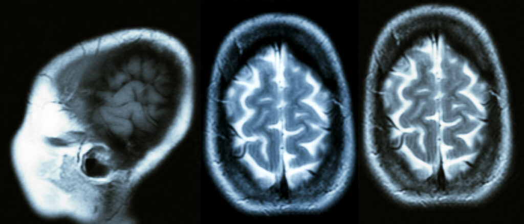 MRI of profile and top view of brain.